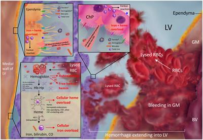 Iron homeostasis and post-hemorrhagic hydrocephalus: a review